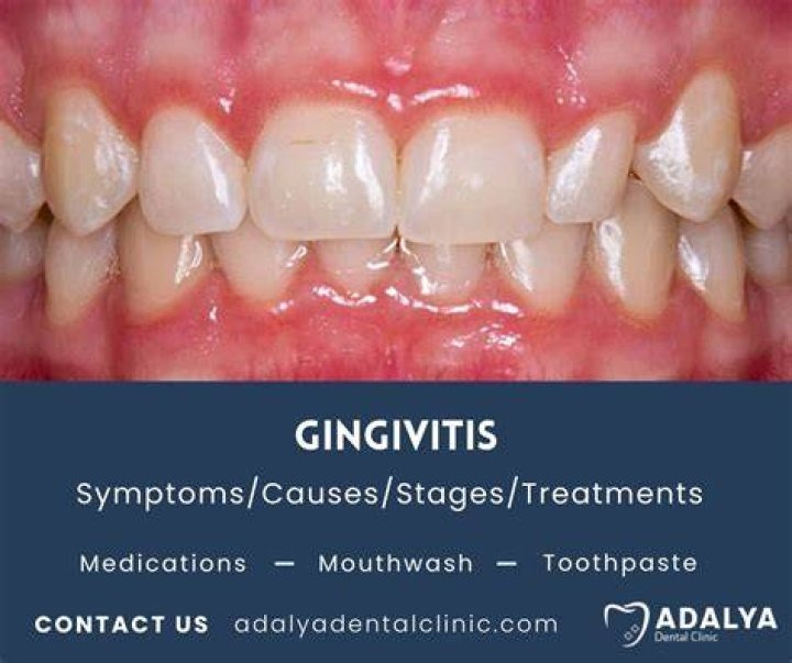 Can Gingivitis Cause white gums?