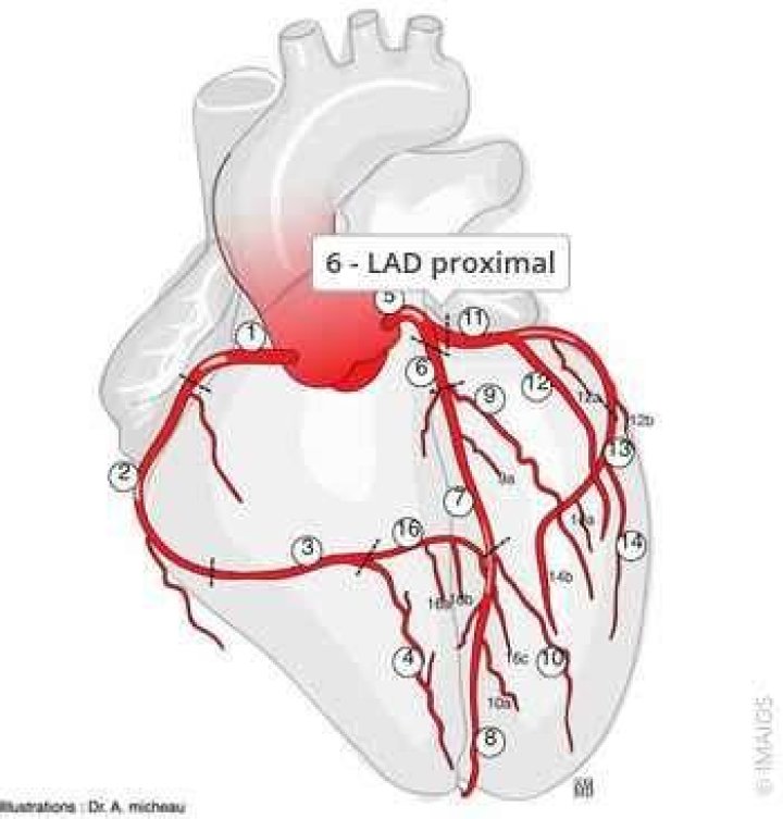 What is a proximal LAD?