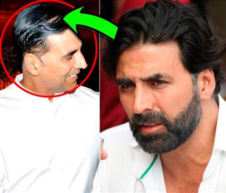 Which Bollywood actor have hair transplant?